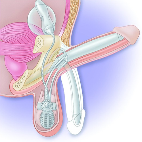 Изображение ПЕНИЛЬНЫЙ ИМПЛАНТ ТРЕХКОМПОНЕНТНЫЙ НАПОЛНЯЕМЫЙ AMS 700