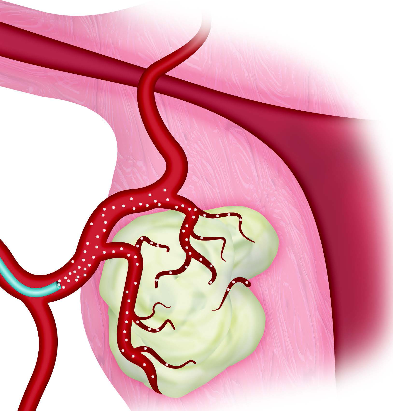 Изображение МИКРОСФЕРЫ ДЛЯ ЭМБОЛИЗАЦИИ EMBOSPHERE