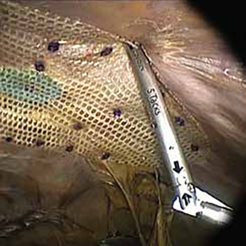 Изображение ГЕРНИОСТЕПЛЕР ЭНДОСКОПИЧЕСКИЙ ИЗГИБАЕМЫЙ С РАССАСЫВАЮЩИМИСЯ СКРЕПКАМИ RELIATACK