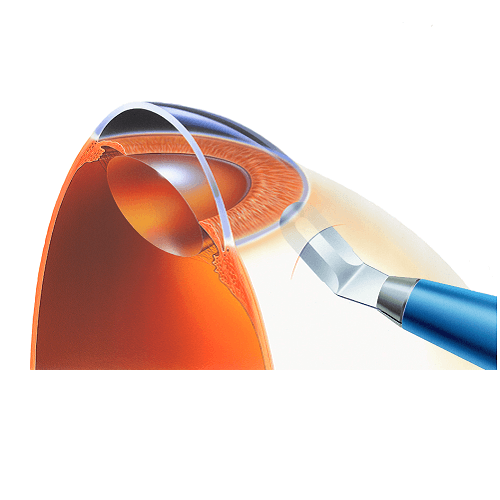 Изображение ПОЛУКРУГЛЫЙ СКАЛЬПЕЛЬ-РАССЛАИВАТЕЛЬ