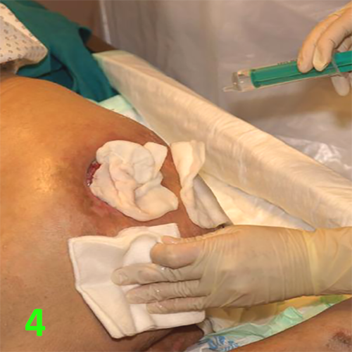 Изображение МЕТОДИКА НАЛОЖЕНИЯ ПОВЯЗКИ С ПРИМЕНЕНИЕМ СУПРАСОРБ CNP