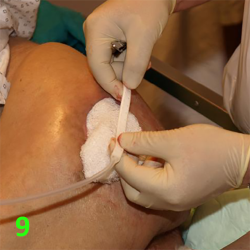 Изображение МЕТОДИКА НАЛОЖЕНИЯ ПОВЯЗКИ С ПРИМЕНЕНИЕМ СУПРАСОРБ CNP