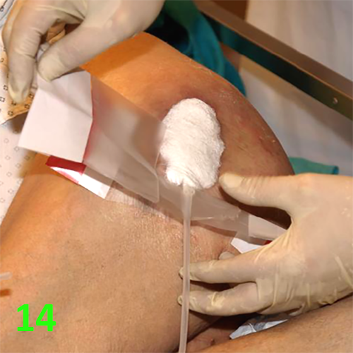 Изображение МЕТОДИКА НАЛОЖЕНИЯ ПОВЯЗКИ С ПРИМЕНЕНИЕМ СУПРАСОРБ CNP