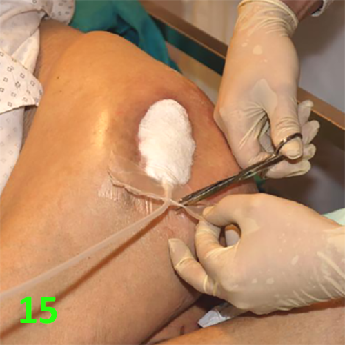 Изображение МЕТОДИКА НАЛОЖЕНИЯ ПОВЯЗКИ С ПРИМЕНЕНИЕМ СУПРАСОРБ CNP