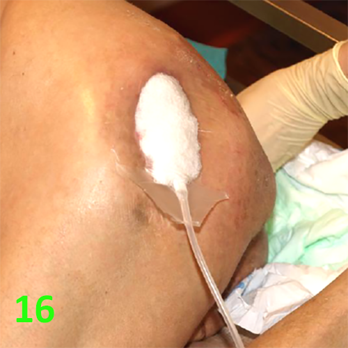 Изображение МЕТОДИКА НАЛОЖЕНИЯ ПОВЯЗКИ С ПРИМЕНЕНИЕМ СУПРАСОРБ CNP