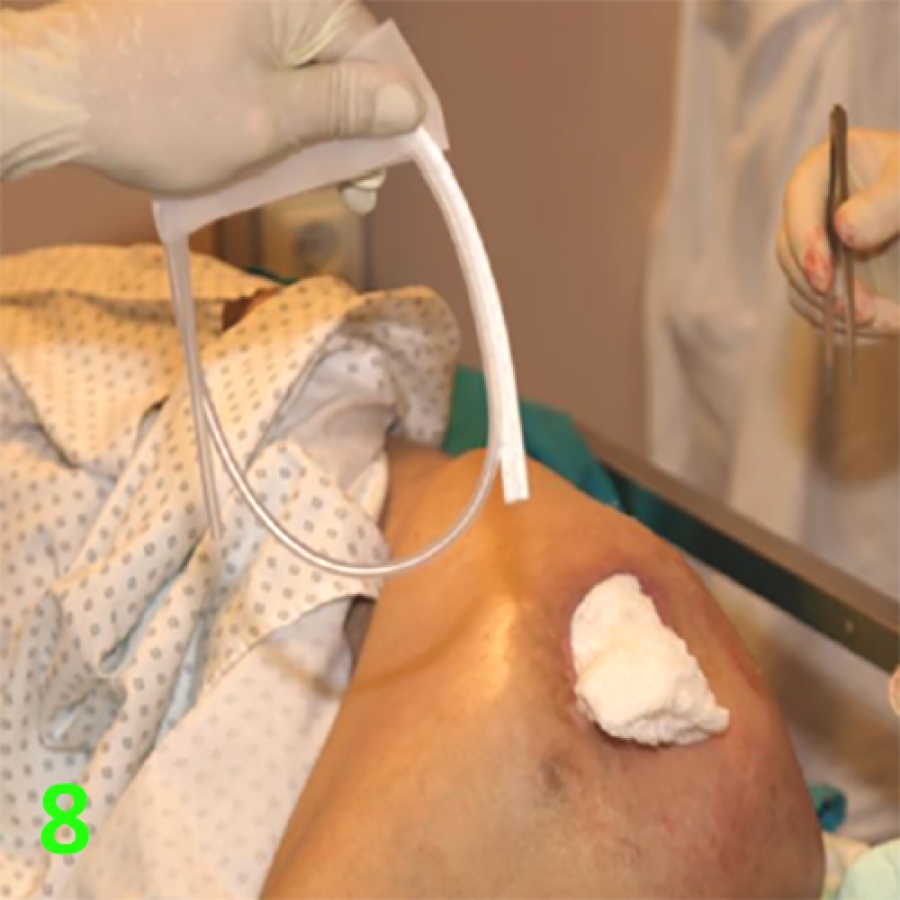 Изображение МЕТОДИКА НАЛОЖЕНИЯ ПОВЯЗКИ С ПРИМЕНЕНИЕМ СУПРАСОРБ CNP