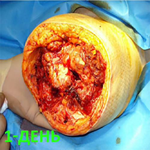 Изображение КЛИНИЧЕСКИЙ СЛУЧАЙ №1. ЭКЗАРТИКУЛЯЦИЯ С РЕВИЗИЕЙ КУЛЬТИ