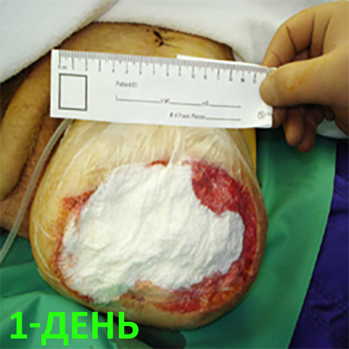 Изображение КЛИНИЧЕСКИЙ СЛУЧАЙ №1. ЭКЗАРТИКУЛЯЦИЯ С РЕВИЗИЕЙ КУЛЬТИ