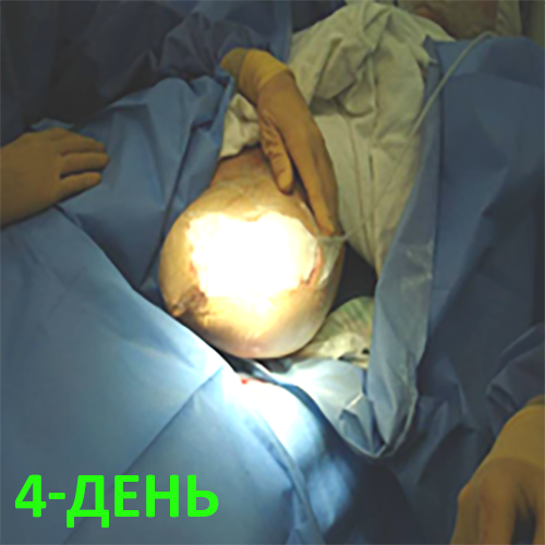 Изображение КЛИНИЧЕСКИЙ СЛУЧАЙ №1. ЭКЗАРТИКУЛЯЦИЯ С РЕВИЗИЕЙ КУЛЬТИ