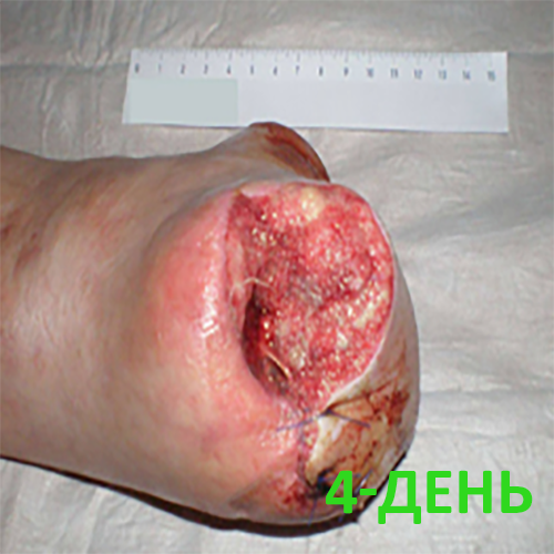 Изображение КЛИНИЧЕСКИЙ СЛУЧАЙ №2. ЗАЖИВЛЕНИЕ ВТОРИЧНЫМ НАТЯЖЕНИЕМ ПОСЛЕ АМПУТАЦИИ СТОПЫ