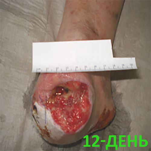 Изображение КЛИНИЧЕСКИЙ СЛУЧАЙ №2. ЗАЖИВЛЕНИЕ ВТОРИЧНЫМ НАТЯЖЕНИЕМ ПОСЛЕ АМПУТАЦИИ СТОПЫ