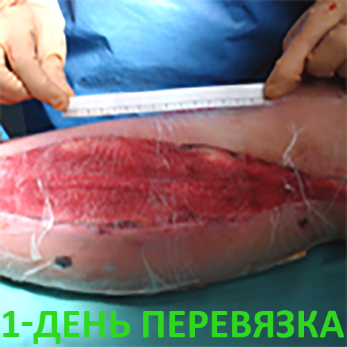 Изображение КЛИНИЧЕСКИЙ СЛУЧАЙ №3. ЗАЖИВЛЕНИЕ ВТОРИЧНЫМ НАТЯЖЕНИЕМ РАНА ПОСЛЕ АКШ