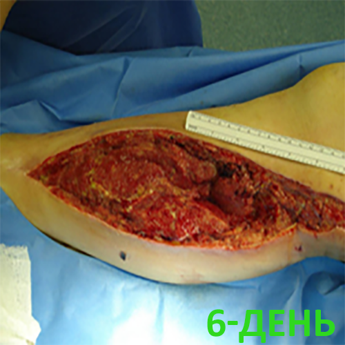 Изображение КЛИНИЧЕСКИЙ СЛУЧАЙ №3. ЗАЖИВЛЕНИЕ ВТОРИЧНЫМ НАТЯЖЕНИЕМ РАНА ПОСЛЕ АКШ