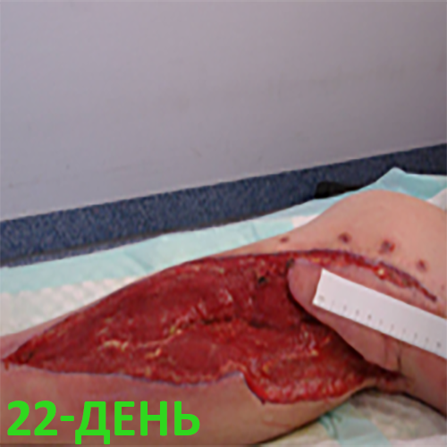 Изображение КЛИНИЧЕСКИЙ СЛУЧАЙ №3. ЗАЖИВЛЕНИЕ ВТОРИЧНЫМ НАТЯЖЕНИЕМ РАНА ПОСЛЕ АКШ