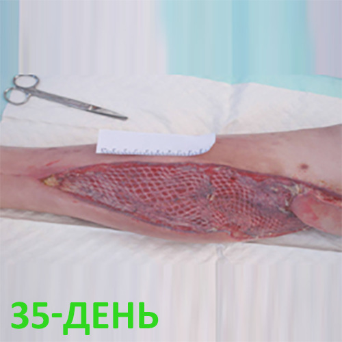 Изображение КЛИНИЧЕСКИЙ СЛУЧАЙ №3. ЗАЖИВЛЕНИЕ ВТОРИЧНЫМ НАТЯЖЕНИЕМ РАНА ПОСЛЕ АКШ