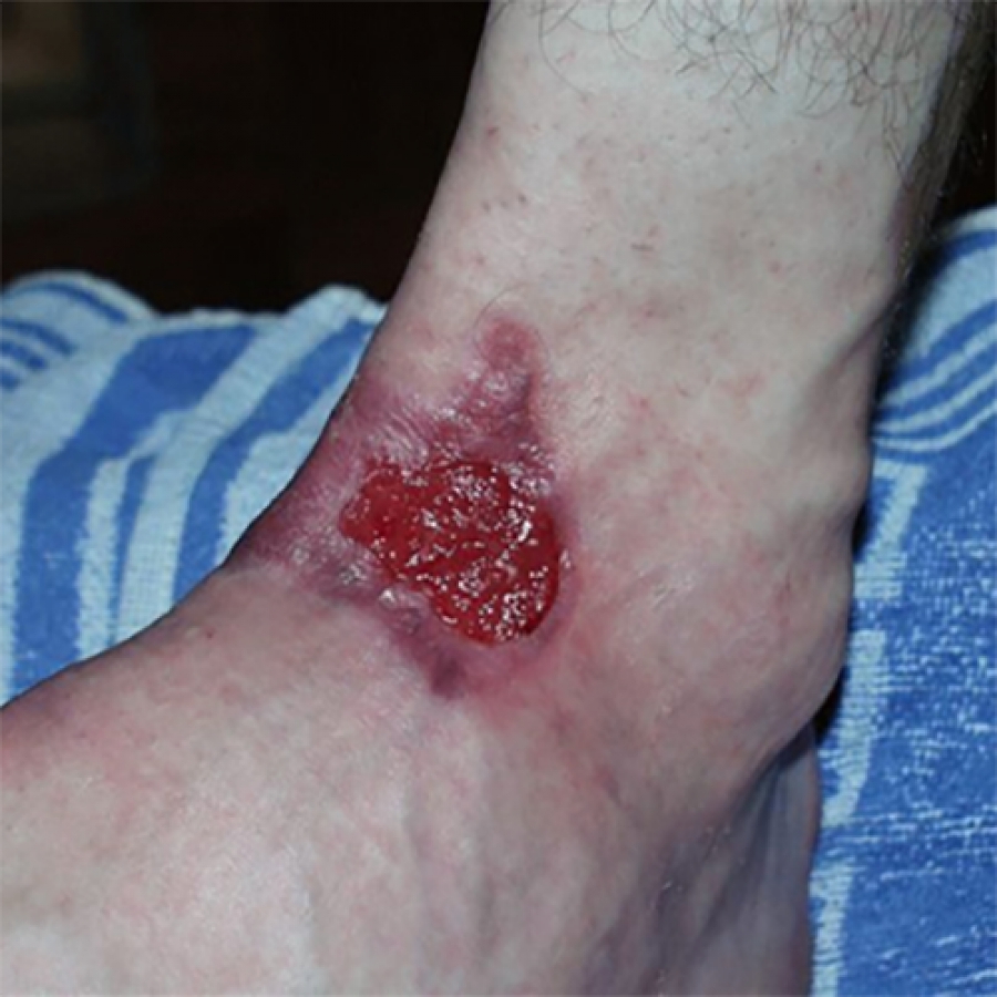 Изображение КЛИНИЧЕСКИЙ СЛУЧАЙ №1. ЛЕЧЕНИЕ ОЖОГА