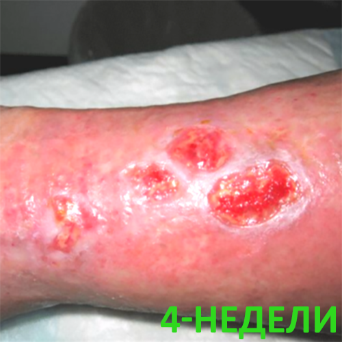 Изображение КЛИНИЧЕСКИЙ СЛУЧАЙ №2. ВЕНОЗНАЯ ЯЗВА