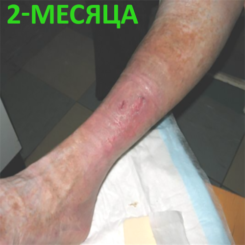 Изображение КЛИНИЧЕСКИЙ СЛУЧАЙ №2. ВЕНОЗНАЯ ЯЗВА
