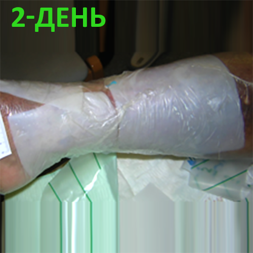 Изображение КЛИНИЧЕСКИЙ СЛУЧАЙ №3. ЯЗВА ГОЛЕНИ