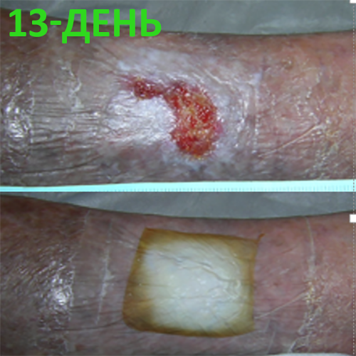 Изображение КЛИНИЧЕСКИЙ СЛУЧАЙ №4. ЯЗВА ГОЛЕНИ