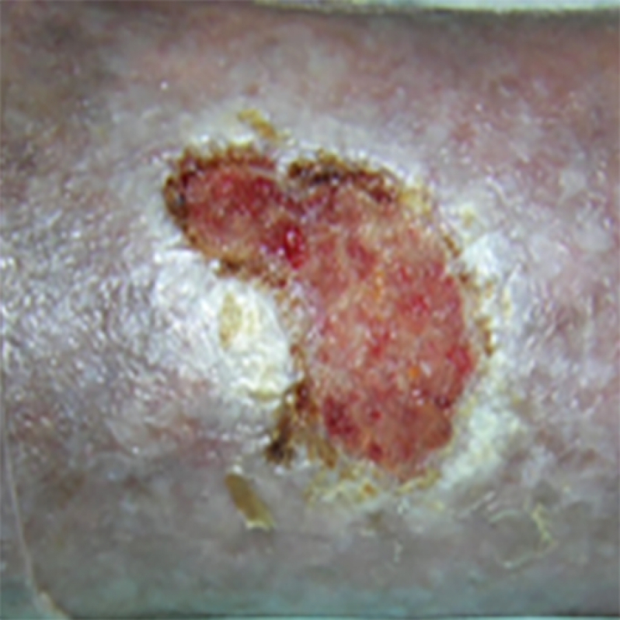 Изображение КЛИНИЧЕСКИЙ СЛУЧАЙ №4. ЯЗВА ГОЛЕНИ