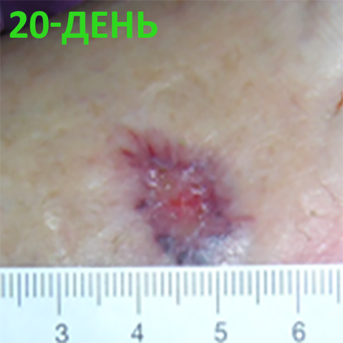 Изображение КЛИНИЧЕСКИЙ СЛУЧАЙ №5. ДИАБЕТИЧЕСКАЯ СТОПА