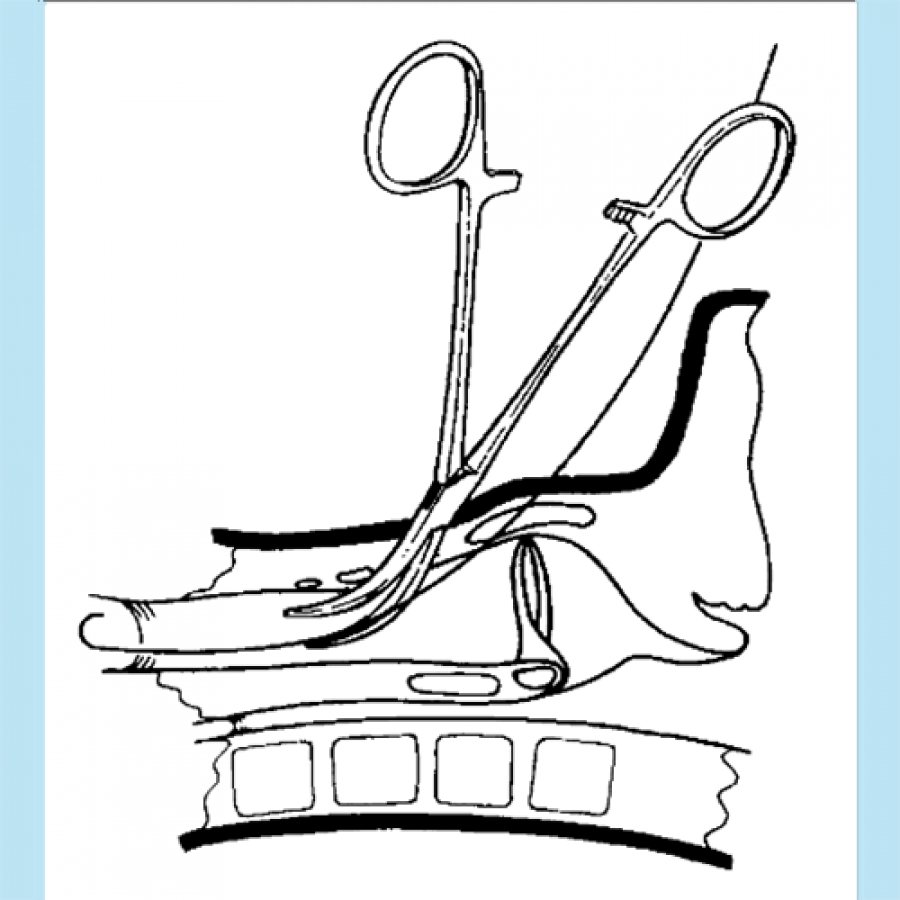 Изображение ЧРЕСКОЖНАЯ ТРАХЕОСТОМИЯ ПО ГРИГГСУ (ПРЕЗЕНТАЦИЯ)