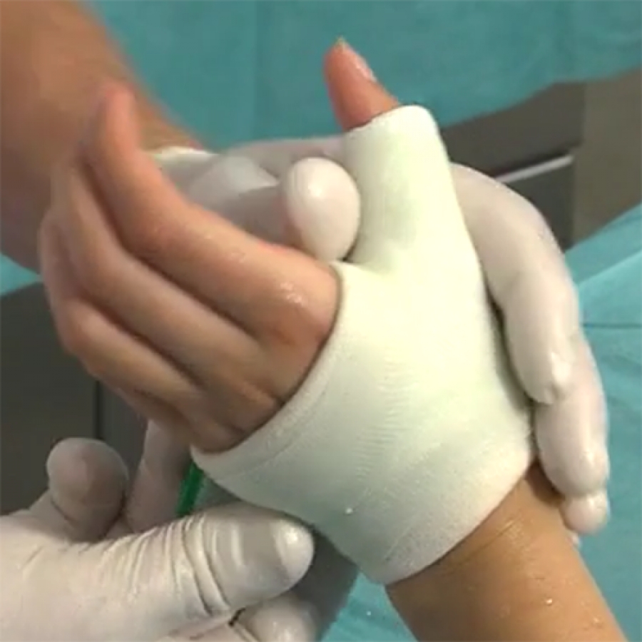 Изображение ПОВЯЗКА ИЗ ЦЕЛЛАКАСТА НА ЗАПЯСТЬЕ (ПЕРЕЛОМ ПЯСТНОЙ КОСТИ)