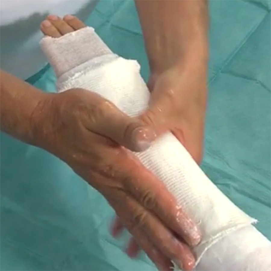 Изображение ЛОНГЕТА ИЗ ЦЕЛЛОНЫ НА ПРЕДПЛЕЧЬЕ