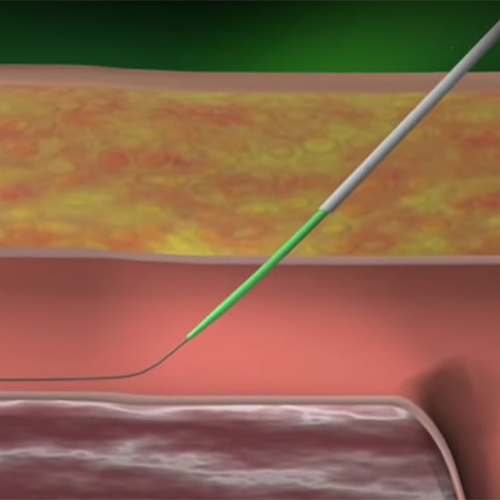 Изображение АНГИОСИЛ УСТРОЙСТВО ДЛЯ ЗАКРЫТИЯ ПУНКЦИИ (ANGIO-SEAL VIP)