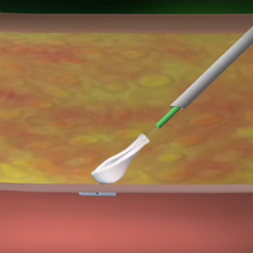 Изображение АНГИОСИЛ УСТРОЙСТВО ДЛЯ ЗАКРЫТИЯ ПУНКЦИИ (ANGIO-SEAL VIP)