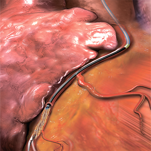 Изображение ЛАЗЕРНЫЙ КАТЕТЕР ELCA ДЛЯ КОРОНАРНЫХ АРТЕРИЙ