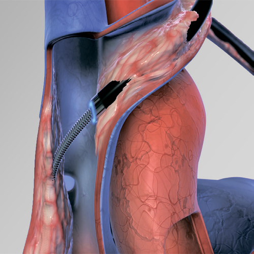 Изображение ЛАЗЕРНЫЙ КАТЕТЕР GLIDE LIGHT ДЛЯ УДАЛЕНИЯ ЭЛЕКТРОДОВ