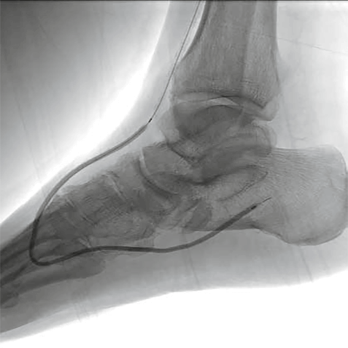 Изображение БАЛЛОННЫЙ КАТЕТЕР COYOTE НА СИСТЕМЕ ДОСТАВКИ ПО ПРОВОДНИКУ OTW (ПРОВОДНИК 0.014'')