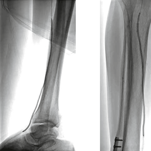 Изображение БАЛЛОННЫЙ КАТЕТЕР COYOTE НА СИСТЕМЕ ДОСТАВКИ ПО ПРОВОДНИКУ OTW (ПРОВОДНИК 0.014'')
