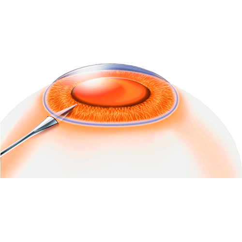 Изображение ВИТРЕОРЕТИНАЛЬНЫЙ СКАЛЬПЕЛЬ