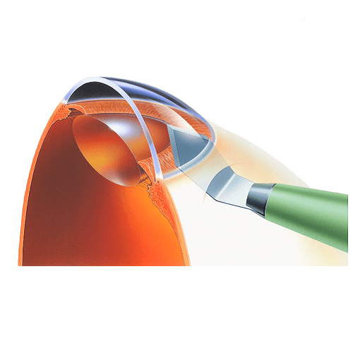 Изображение КЕРАТОМЫ ОФТАЛЬМОЛОГИЧЕСКИЕ СКАЛЬПЕЛИ