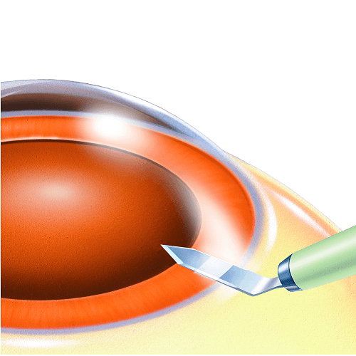 Изображение КЕРАТОМЫ BUPS