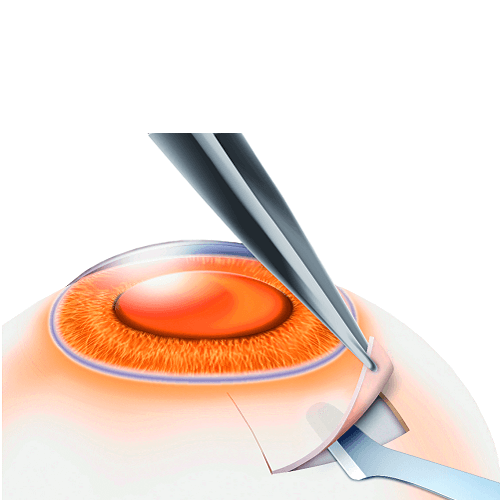 Изображение СКАЛЬПЕЛЬ-РАССЛАИВАТЕЛЬ В ФОРМЕ КЛЮШКИ