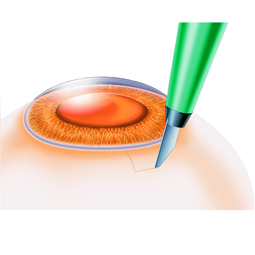 Изображение ГЛАУКОМНЫЙ СКАЛЬПЕЛЬ