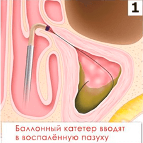 Изображение КАТЕТЕР ПРОВОДНИКОВЫЙ MESIRE