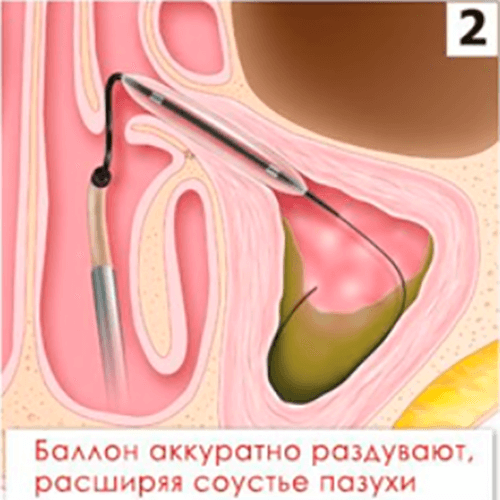 Изображение КАТЕТЕР ПРОВОДНИКОВЫЙ MESIRE