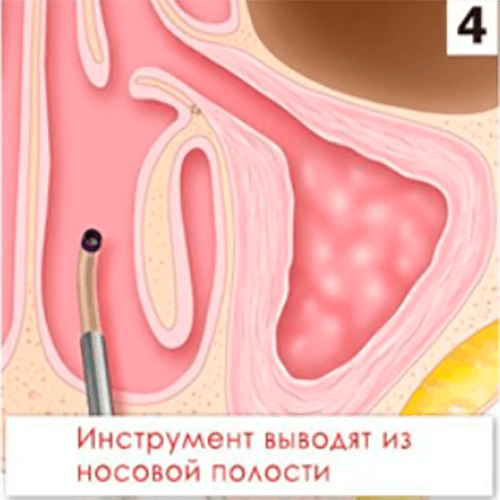 Изображение КАТЕТЕР ПРОВОДНИКОВЫЙ MESIRE