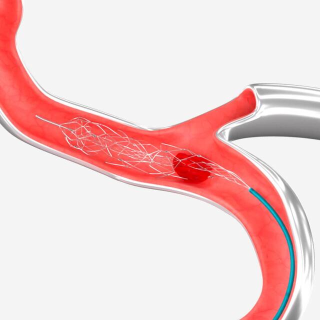 Изображение УСТРОЙСТВО ДЛЯ ВНУТРИСОСУДИСТОЙ ТРОМБОЭКТОМИИ EMBOTRAP III