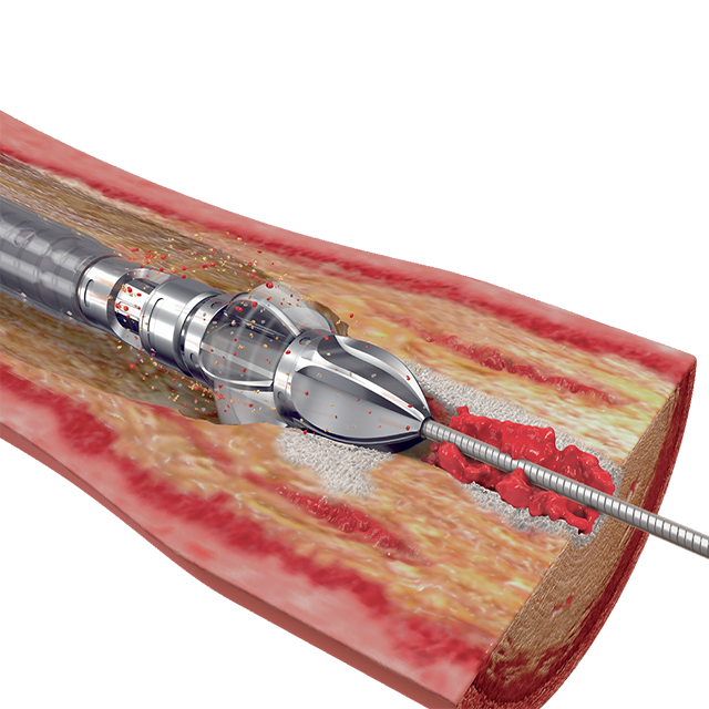 Изображение КАТЕТЕРЫ ДЛЯ ПРОВЕДЕНИЯ АРТЕРЭКТОМИИ JETSTREAM XC И SC