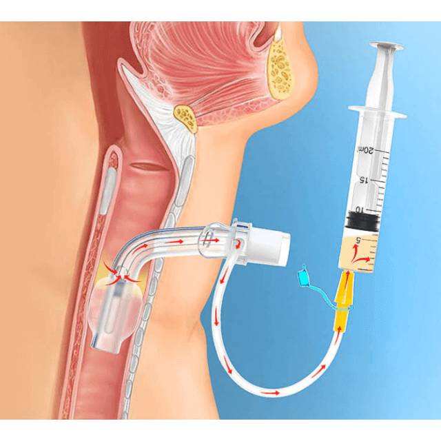 Изображение ТРАХЕОСТОМИЧЕСКАЯ ТРУБКА TRACHEOSOFT С КАНАЛОМ ДЛЯ САНАЦИИ НАДМАНЖЕТОЧНОГО ПРОСТРАНСТВА