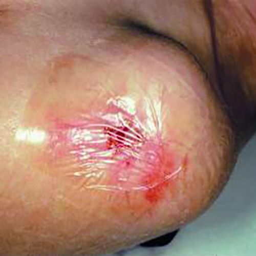 Изображение СУПРАСОРБ F (SUPRASORB F) ПЛЕНКА ЗАЩИТНАЯ