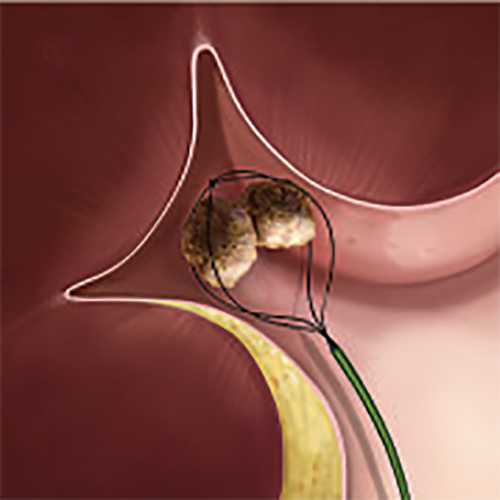 Изображение НИТИНОЛОВАЯ КОРЗИНА ДЛЯ ЛИТОЭКСТРАКЦИИ ZERO TIP