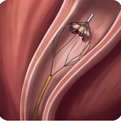 Изображение МУЛЬТИСТРУННАЯ КОНСТРУКЦИЯ ДЛЯ ИЗВЛЕЧЕНИЯ КАМНЕЙ LESLIE PARACHUTE