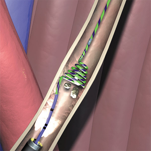 Изображение ЛОВУШКИ ДЛЯ ПРЕДОТВРАЩЕНИЯ МИГРАЦИИ КАМНЕЙ В МОЧЕТОЧНИКЕ STONE CONE